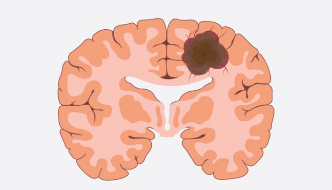 Neuro-Oncology